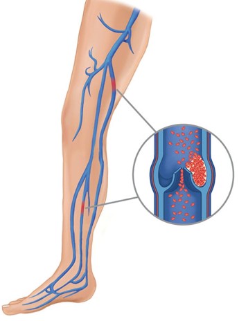 The causes of varicose veins(1)