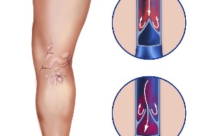 Complications from varicose veins
