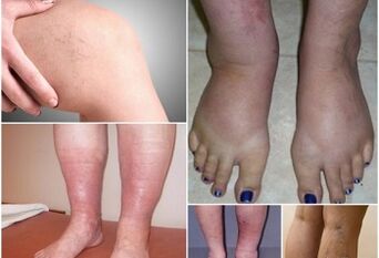Photos of manifestations of varicose veins in the legs