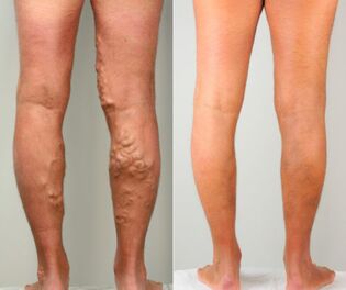 Stages of varicose veins of the legs. 