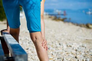 Varicose veins of the lower extremities due to physical effort