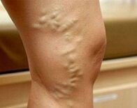 Varicose veins of the lower extremities during pregnancy. 