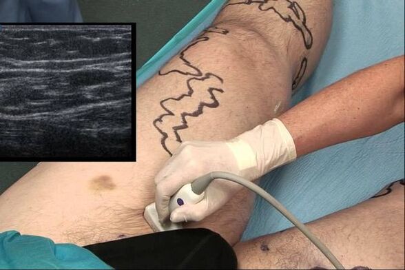 Diagnosis of varicose veins in men.