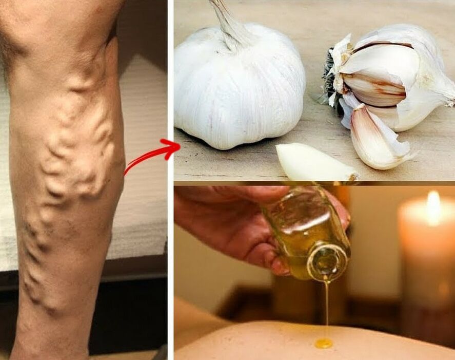 Home remedies for the treatment of varicose veins. 
