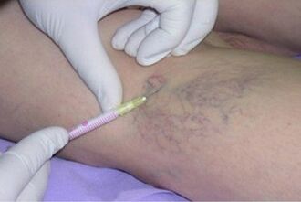 sclerotherapy as a method to treat varicose veins