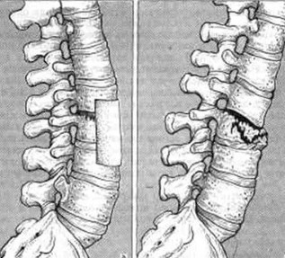 Injuries in the lumbar region