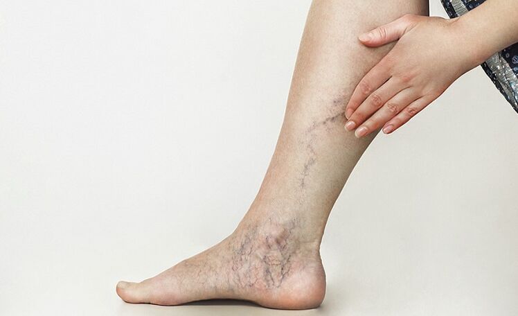 varicose veins and their treatment with home remedies