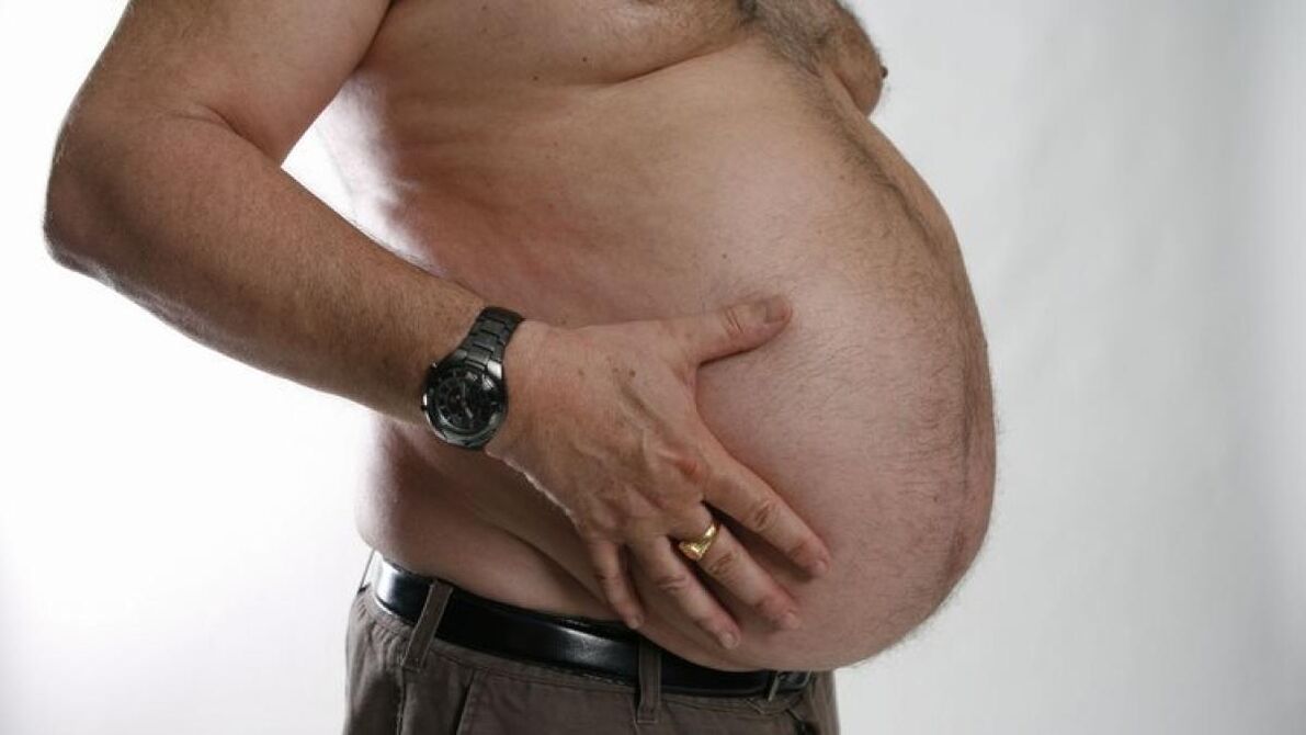 Obesity as a cause of the development of varicose veins. 