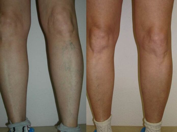 legs before and after varicose vein laser treatment