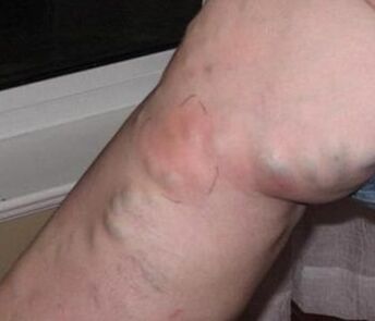 Thrombophlebitis in the leg with varicose veins. 
