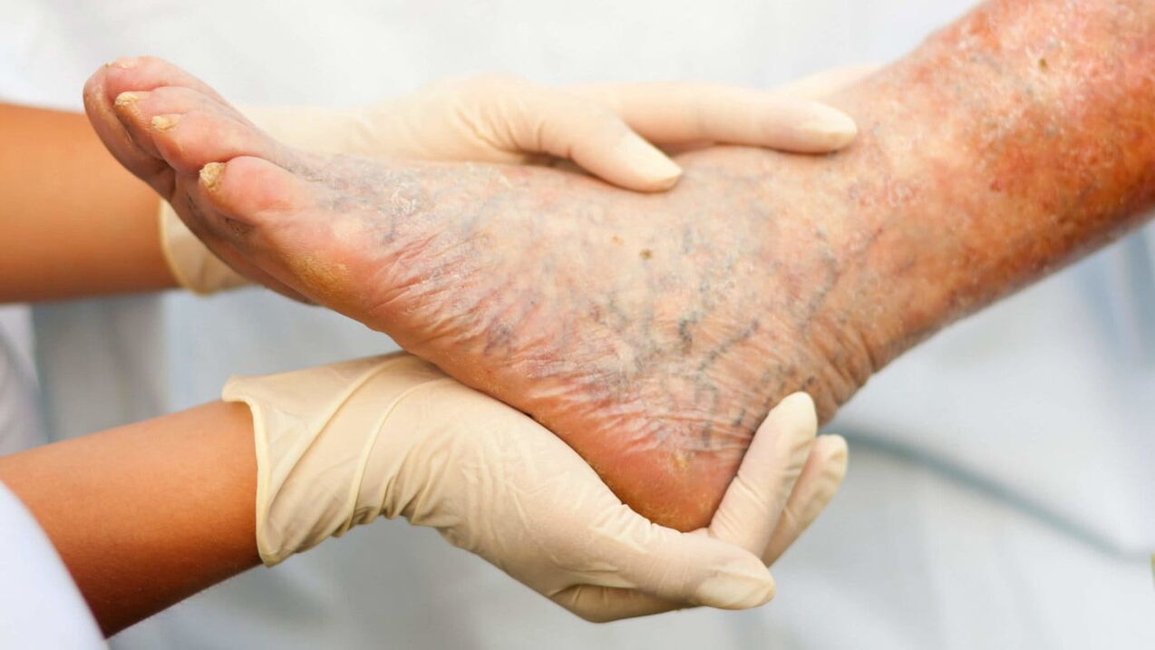 The phlebologist deals with the treatment of varicose veins in the legs. 