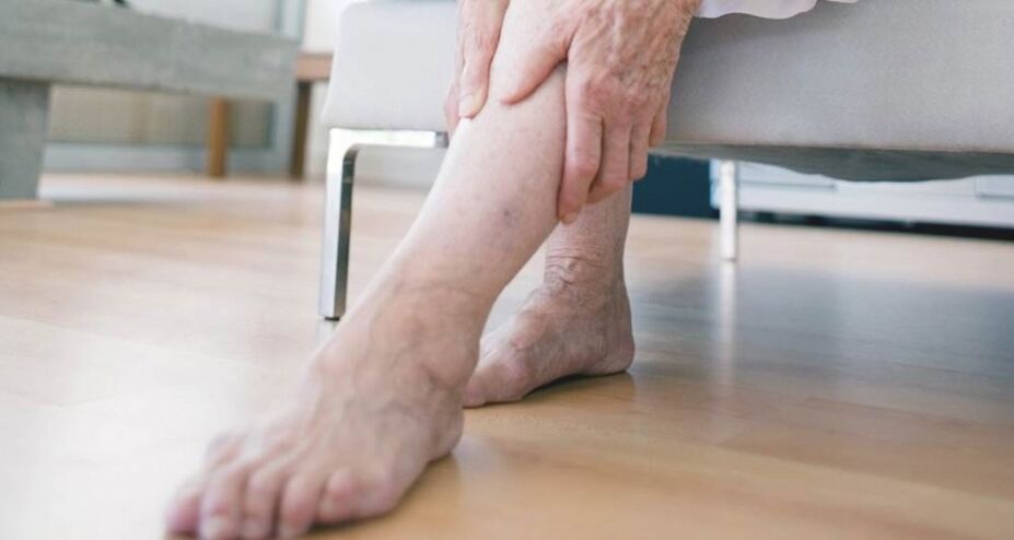 Varicose veins of the lower extremities caused by venous valve malfunction