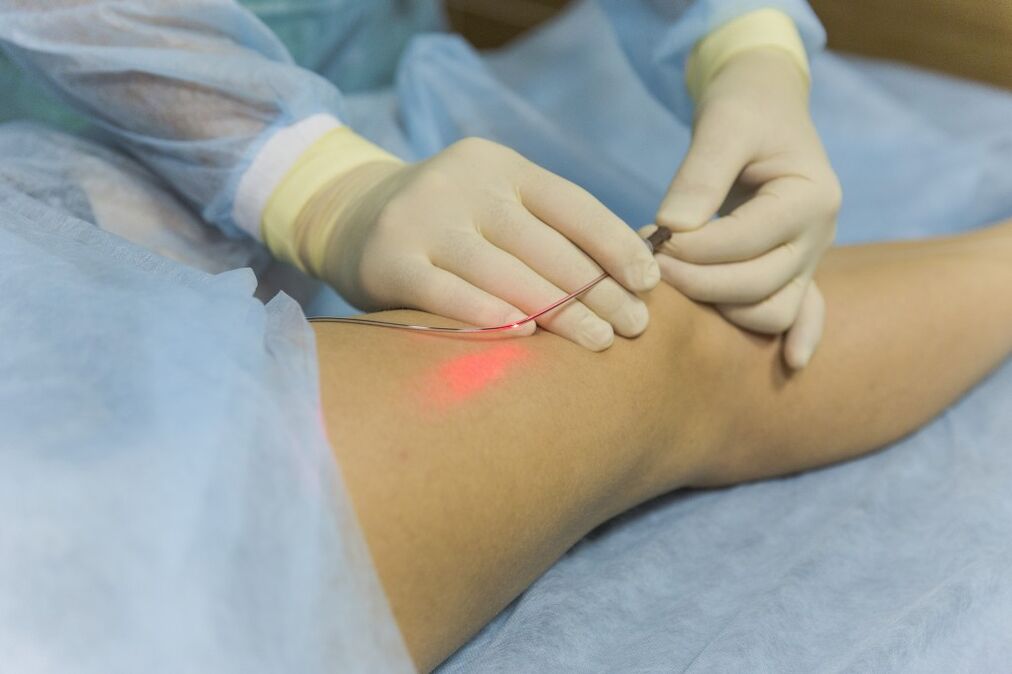 Laser treatment of varicose veins of the lower extremities. 