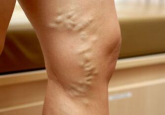 Varicose veins in the legs of a woman. 