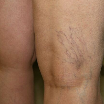 Venous mesh in the lower extremities is a sign of varicose veins