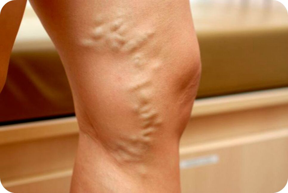 Varicose veins of the veins