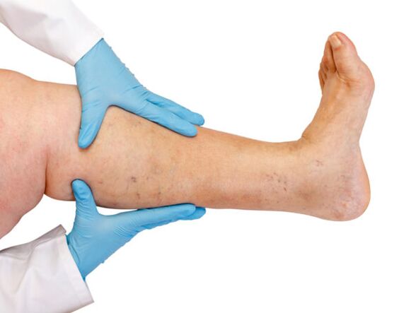 Varicose veins on the legs