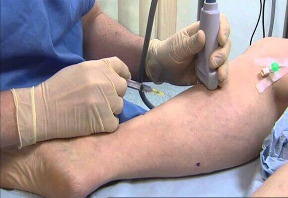 Treatment of varicose veins