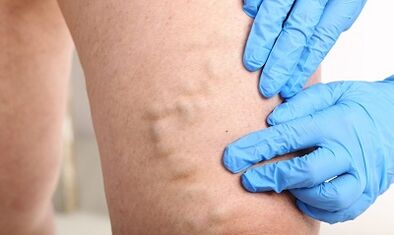 Varicose veins on the legs