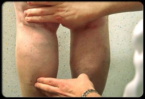 The doctor examines legs with varicose veins