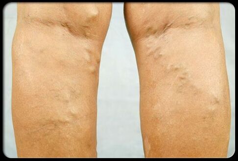 Varicose veins on the legs