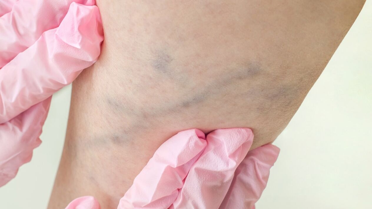 Varicose veins of the lower extremities.