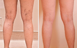 Before and after sclerotherapy